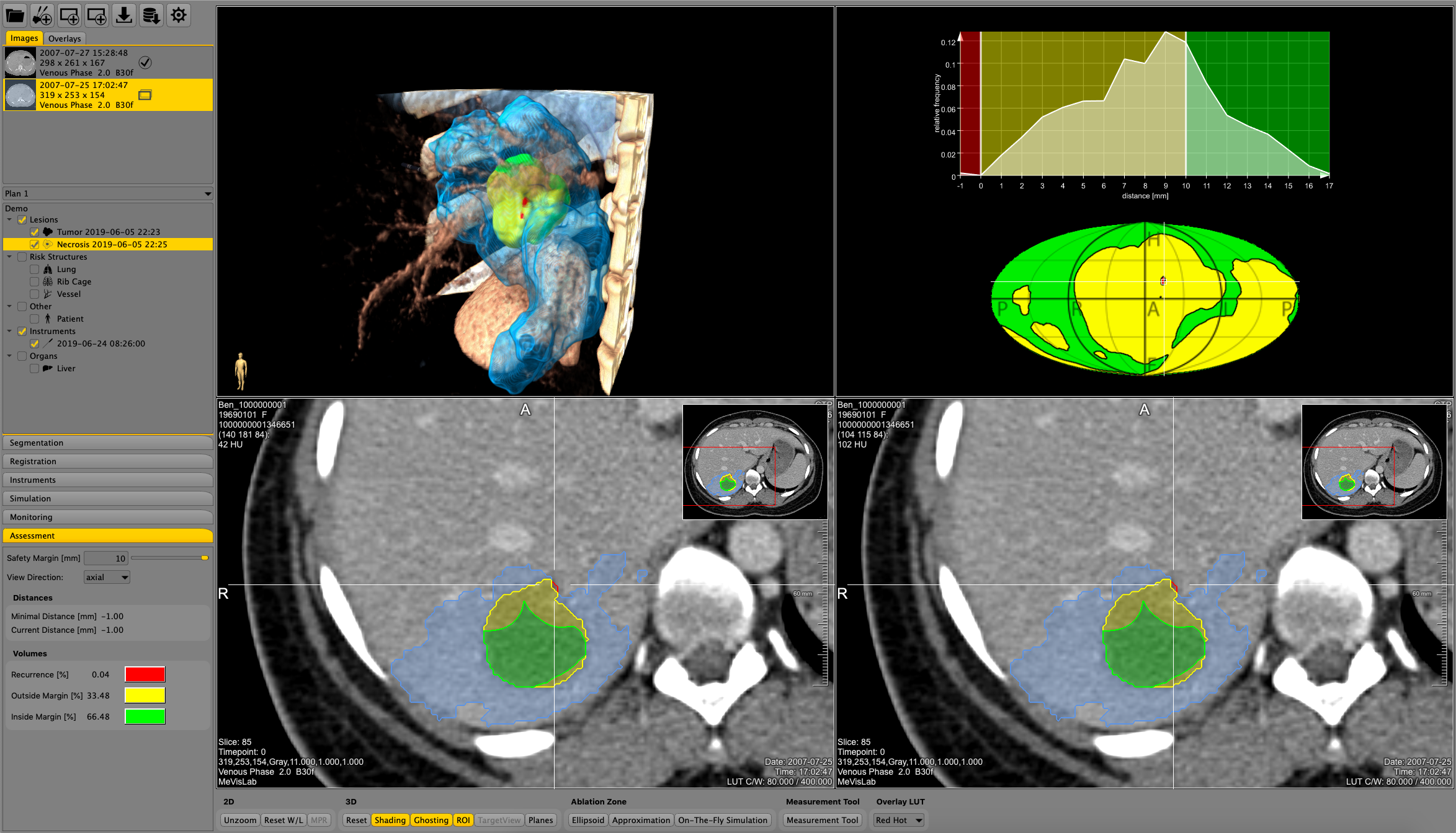 The software assistant for interventional radiology (SAFIR) helps assessing the risk for recurrences by comparing pre- and post-interventional images through image registration and display of safety margins by a traffic light color scheme.