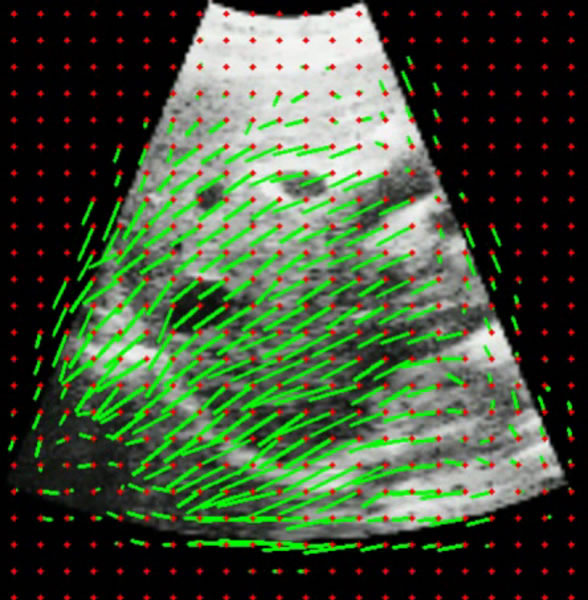 Herausforderung Leber-Ultraschall überlagertes Deformations-Feld