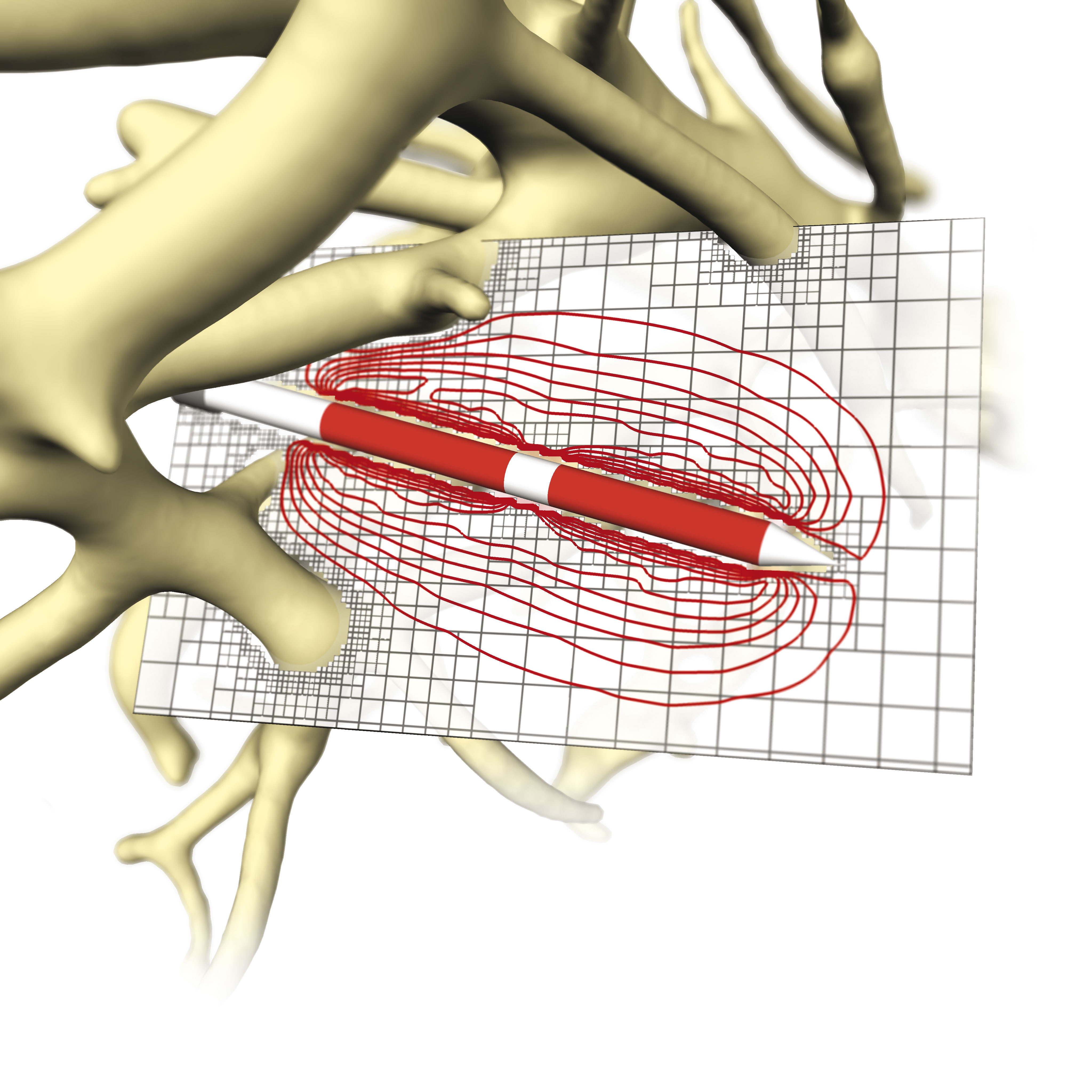 Temperaturverteilung bei einer Hochfrequenzstrom-Ablation