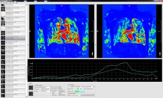 Lungen-MR Durchblutung Softwaregestützte Analyse
