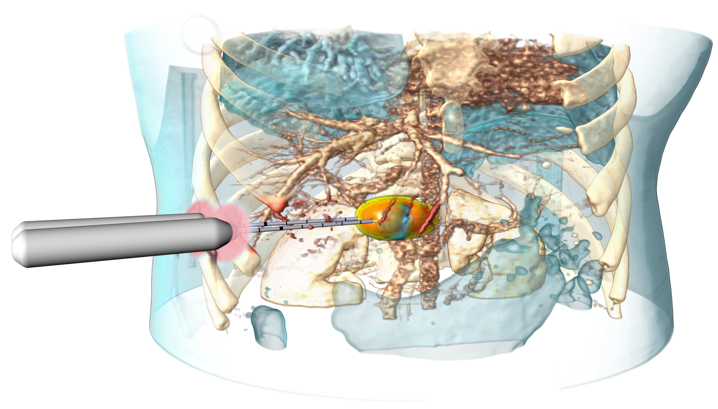 Software Assistant for Interventional Radiology SAFIR Lebertumor