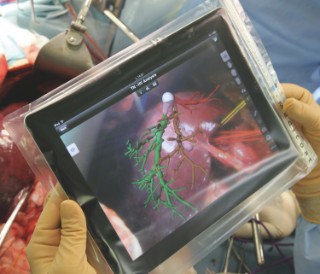 Hepatic vasculature and resection strategy resulting from the preoperative planning are visualized on the tablet and provide guidance during surgical incision.