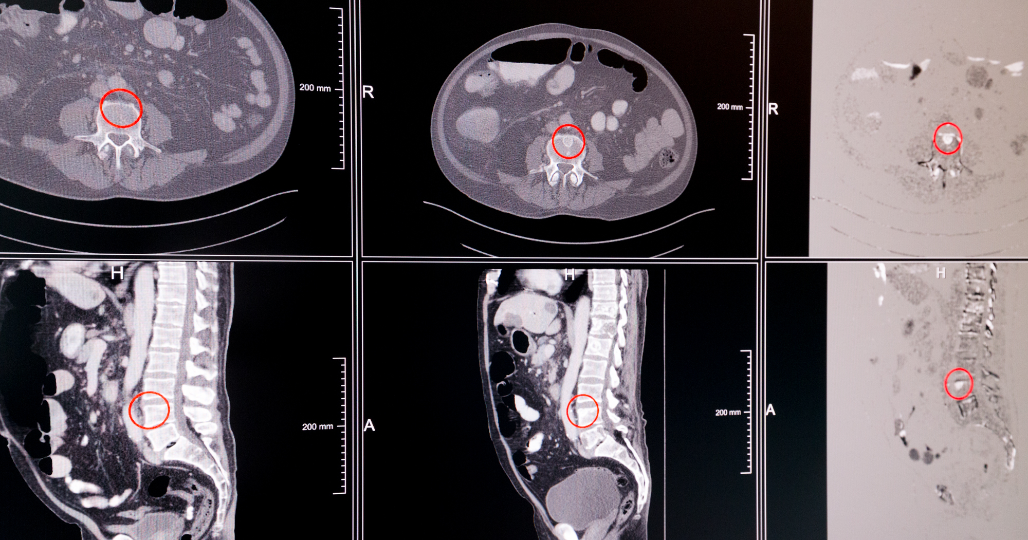 Two CT images in the course of therapy with subtraction representation indicating a newly formed bone tumor