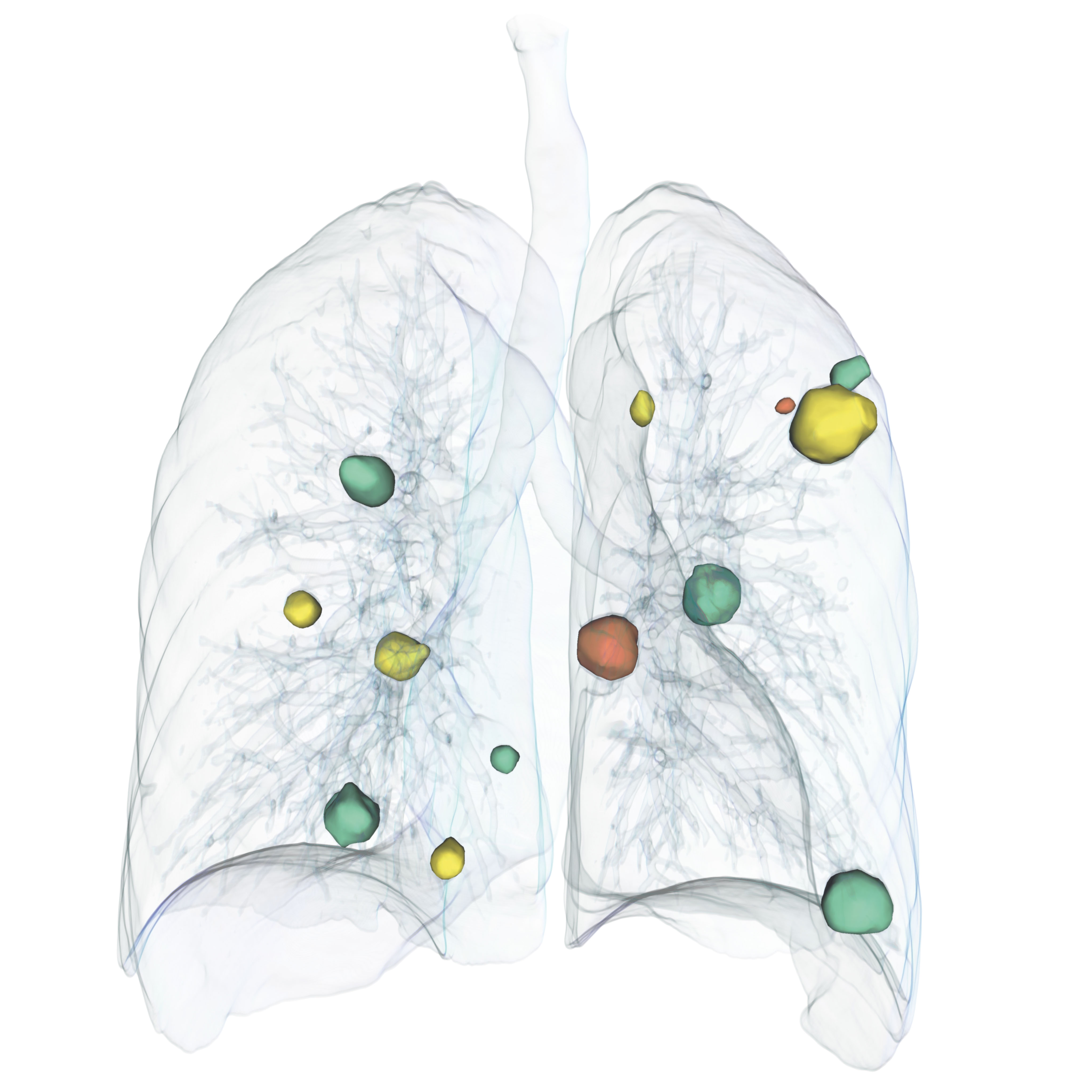 Volume rendering of a lung showing the volume development of tumor volume.