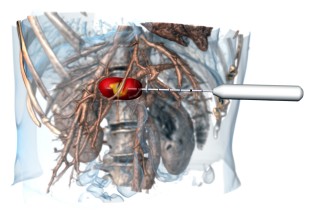 Radiofrequency applicator RFA Radio Frequence Ablation in Liver Tumor