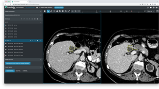 Screenshot of a prototypical program that finds and measures tumors in pairs of images.