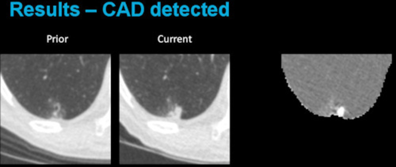 Results of Computer Aided Detection CAD in lung CT images