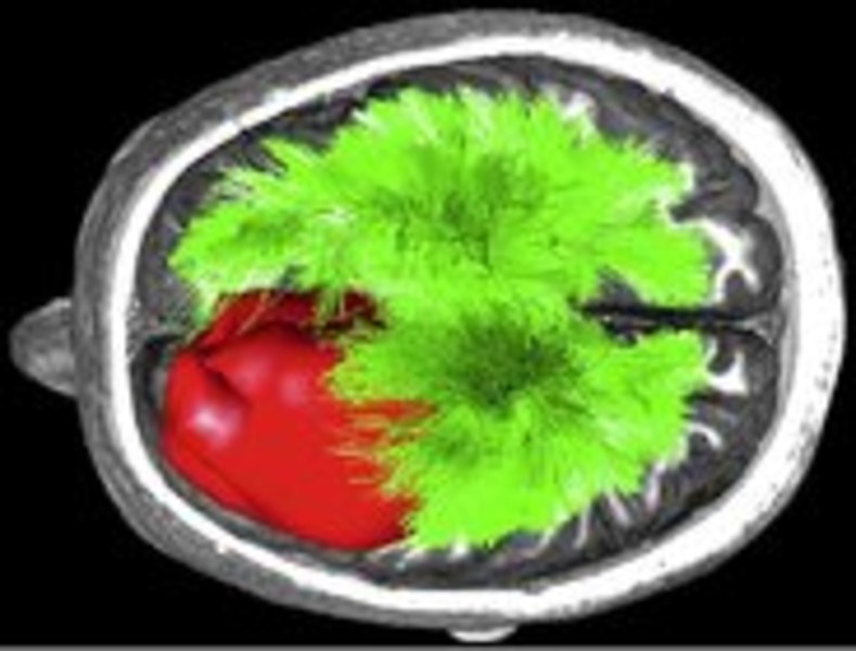  reconstruction of High Angular Resolution Diffusion Imaging Data (HARDI), analysis of white matter