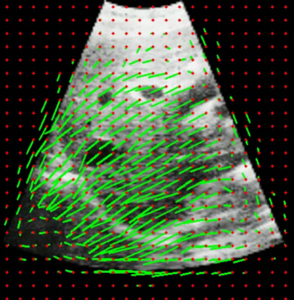 Challenge on Liver Ultrasound Tracking CLUST overlayed defomration field