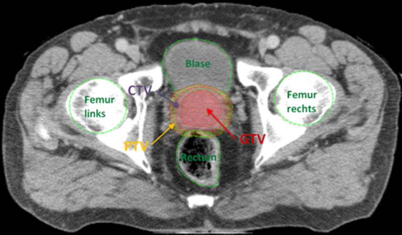 bachelor thesis of Jennifer Nitsch: segmentation of the bladder based on CT data without contrast agent