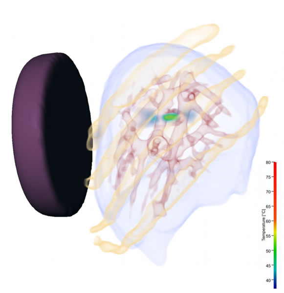 Temperature Distribution after a single steered sonication of the liver