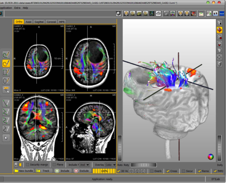 NeuroQLab - one application combines fMRI and DTI to visualize and quantify areas in the human brain