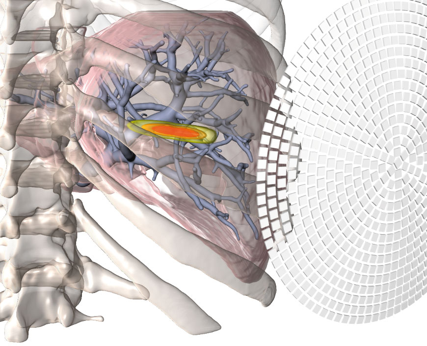 Focused Ultrasound Surgery In Moving Organs FUSIMO