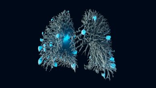 Lung metastases 