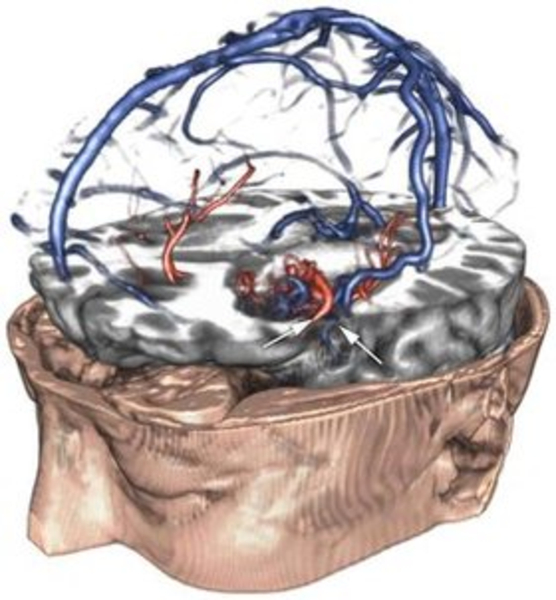 Multi-volume visualization of a patient dataset with a larg AVM. brain vessels