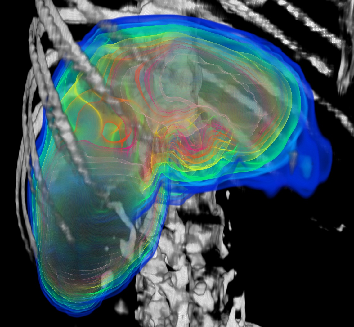 Dosimetry in the liver