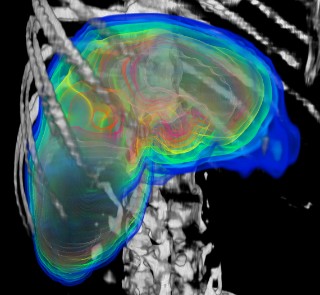 Dosimetry in the liver