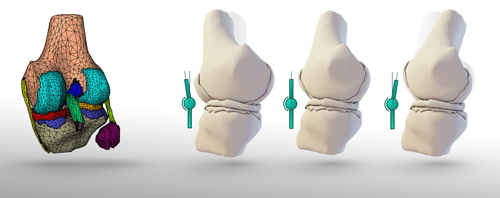 The finite element simulation model of the knee joint enables precise dynamic prediction and analysis of various joint positions, including hyperextension, resting position, and 20° flexion. The simulation is based on an MR dataset from the University Hospital of Freiburg.