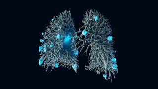 Volume rendering of vascular tree and metastases in the lung