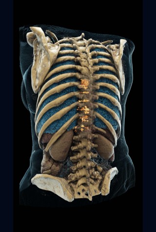 Bone Metastases