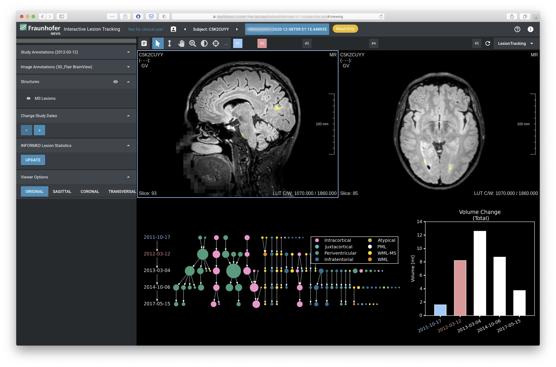 SATORI with white matter lesions in MRI and a custom lesion tracking extension showing how lesions split and merge over time