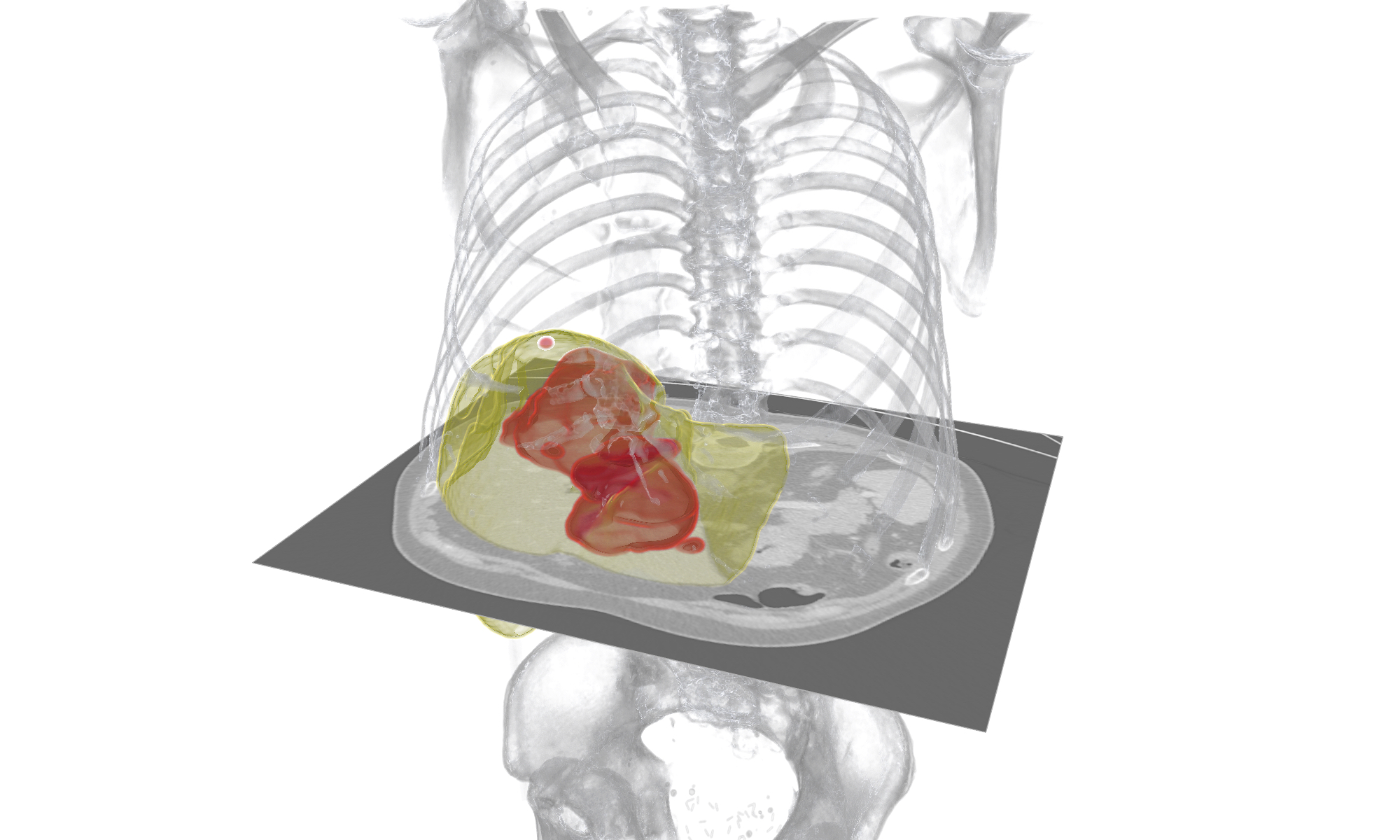 Automatic liver and tumor segmentation.