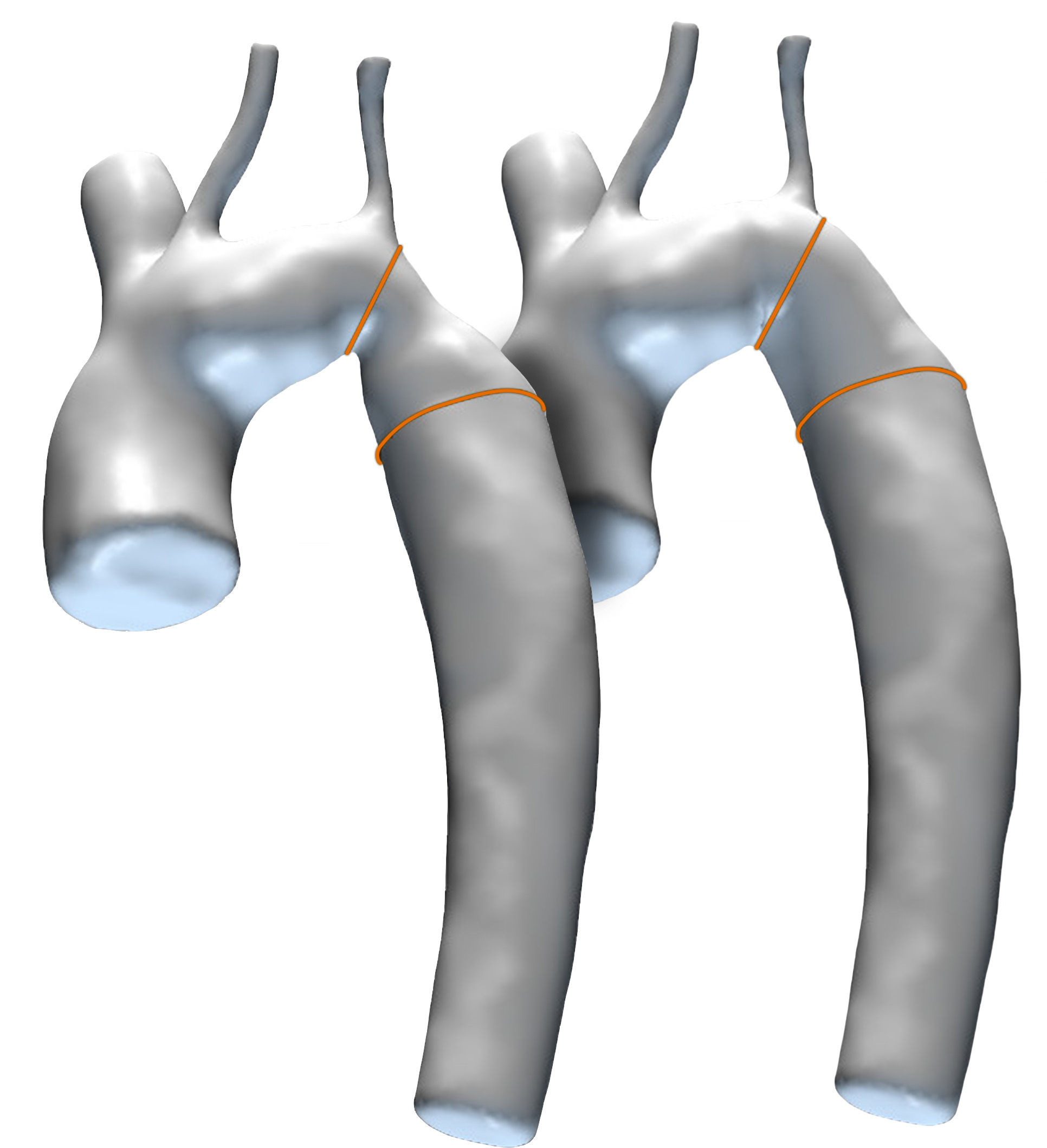 Aorta Virtual Stenting