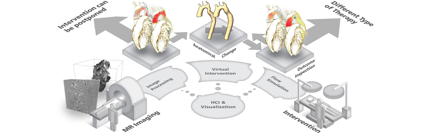 Integration of the image-based virtual interventions in the therapy planning of coarctation of the aorta.