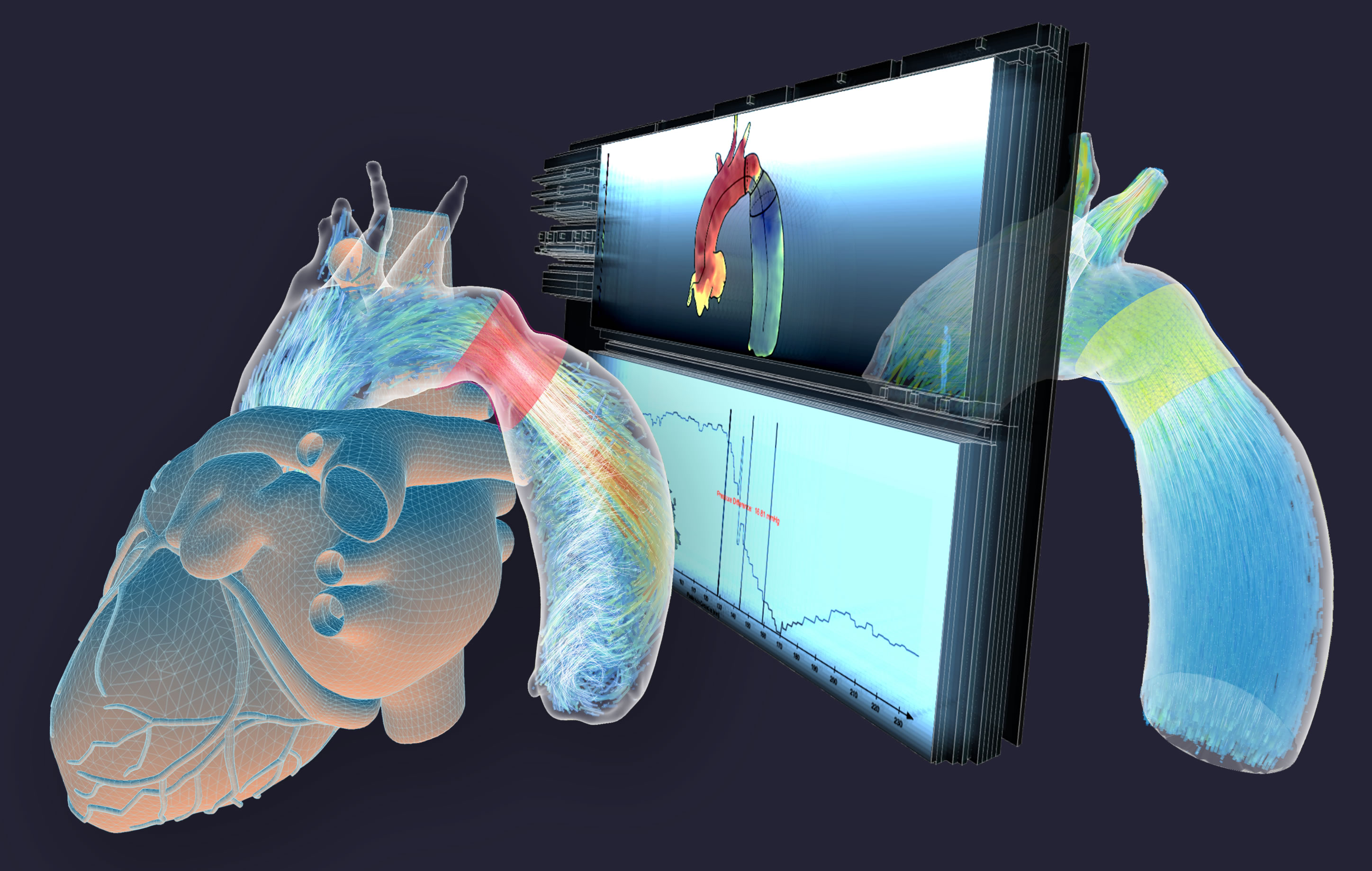 Virtual stenting of an aortic coarctation (red) and outcome simulation with the web-based Extento tool.